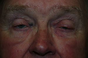 Blepharoplasty 7a